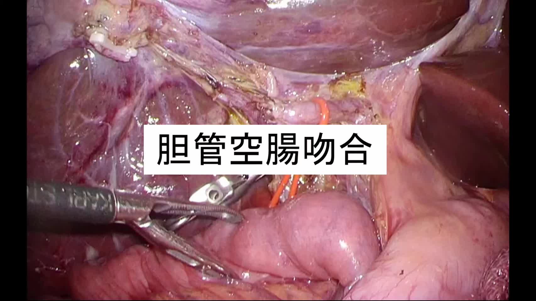 動画2.胆管空腸吻合