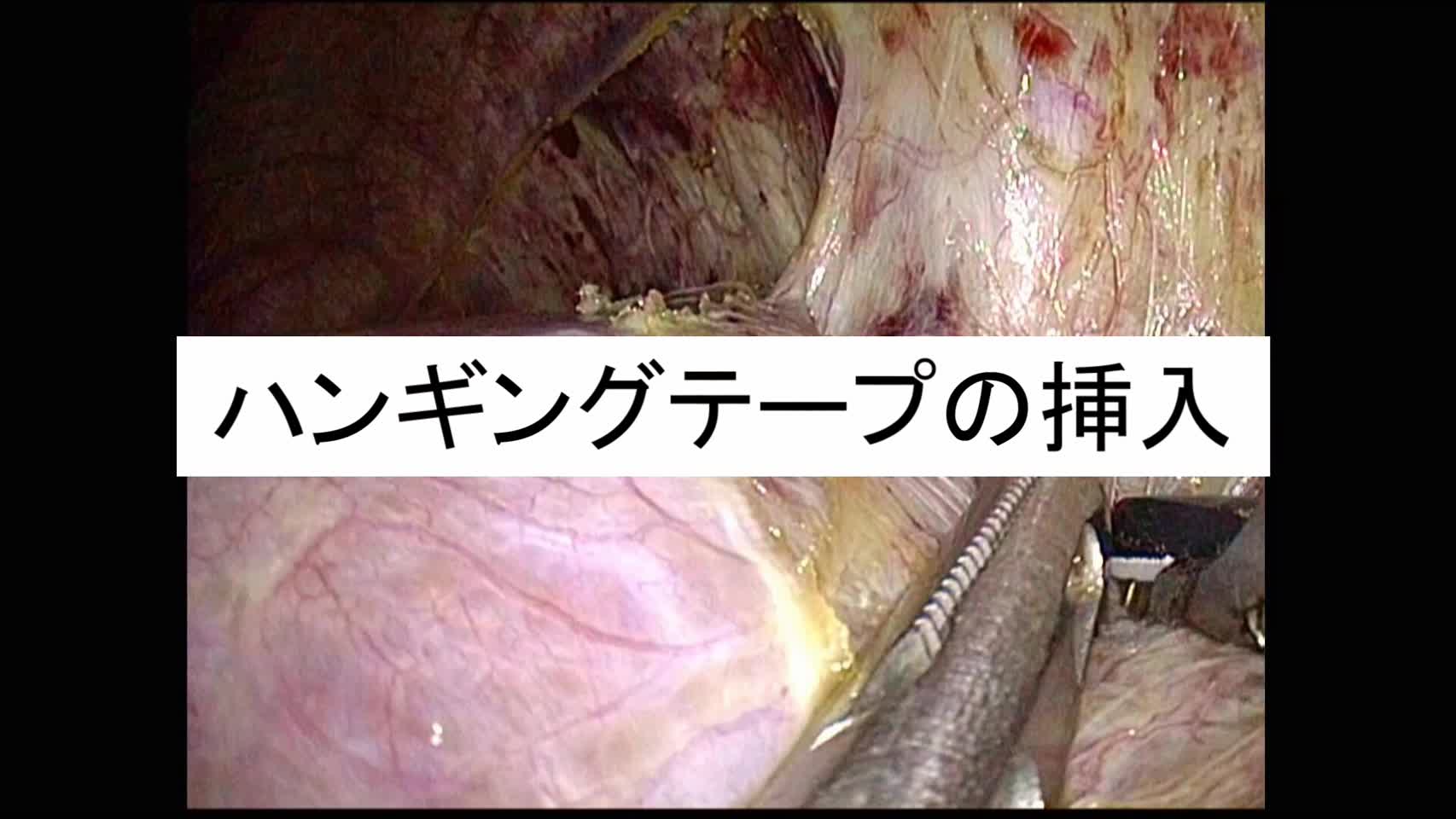 動画1.ハンギングテープの挿入