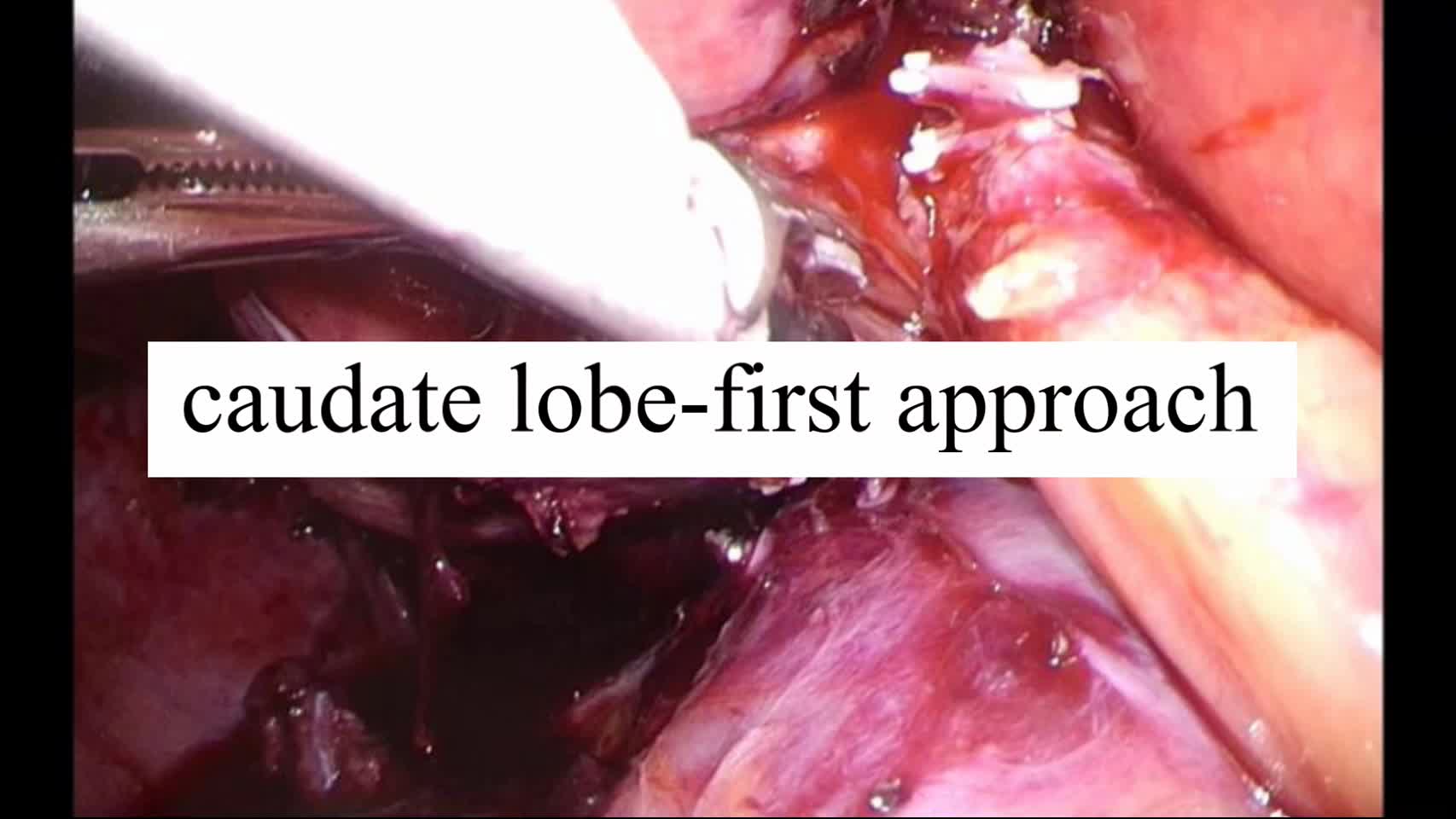 動画2.caudate lobe-first approach