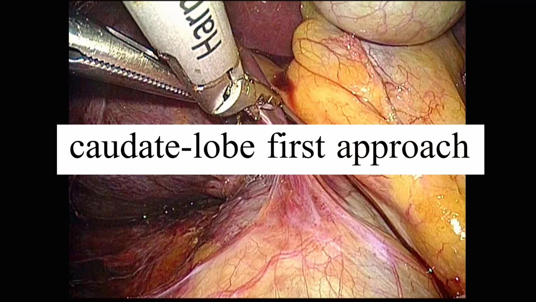 動画1. caudate lobe-first approach