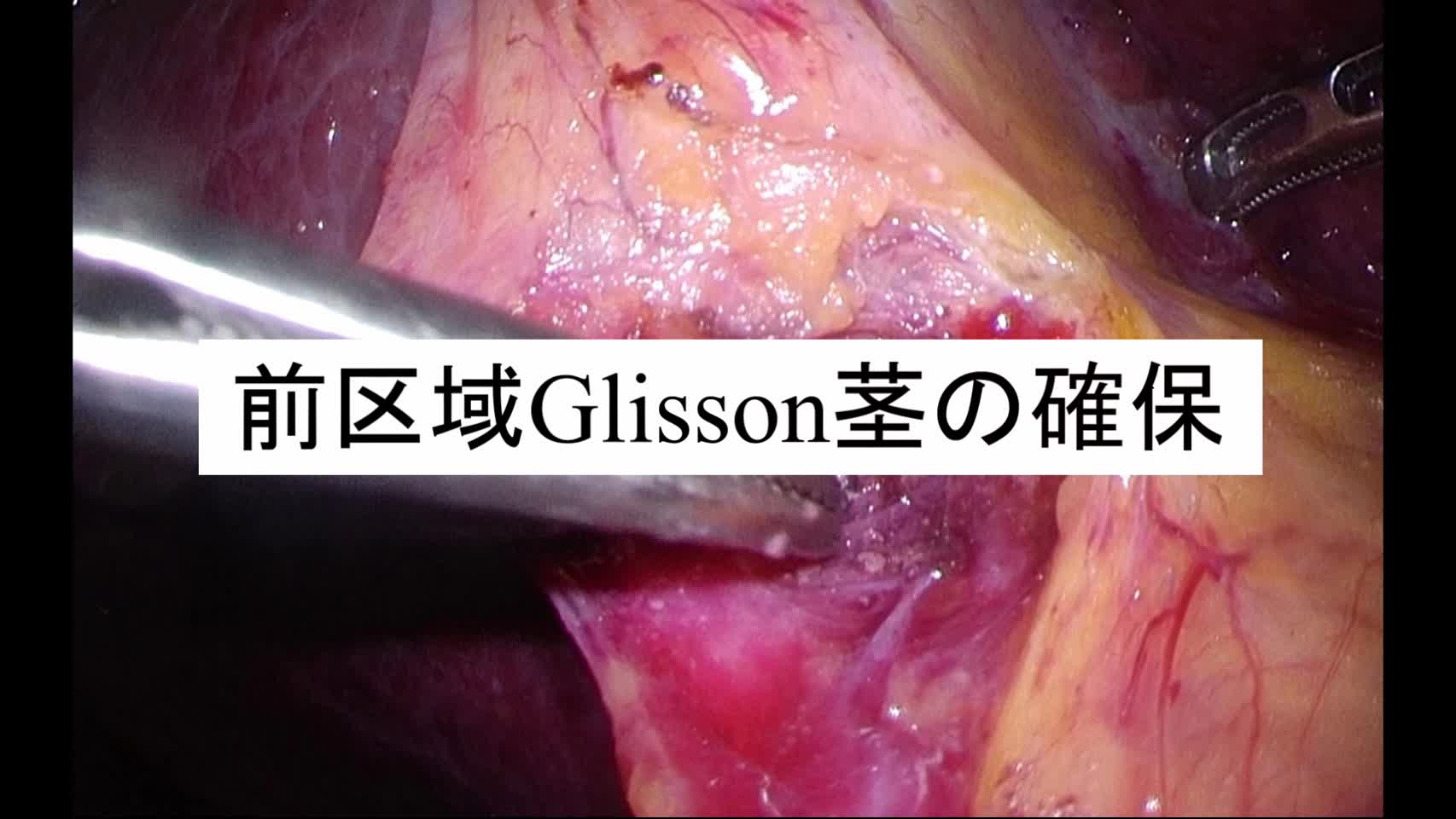 動画1. 前区域Glisson茎の確保