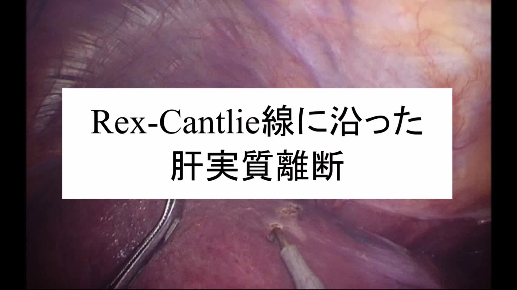 動画2. Rex-Cantlie線に沿った肝実質離断