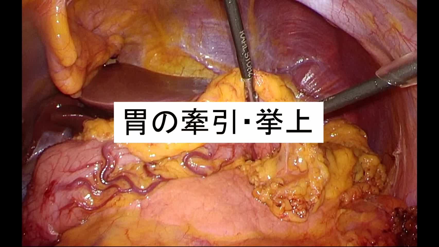 動画4.胃の牽引・挙上