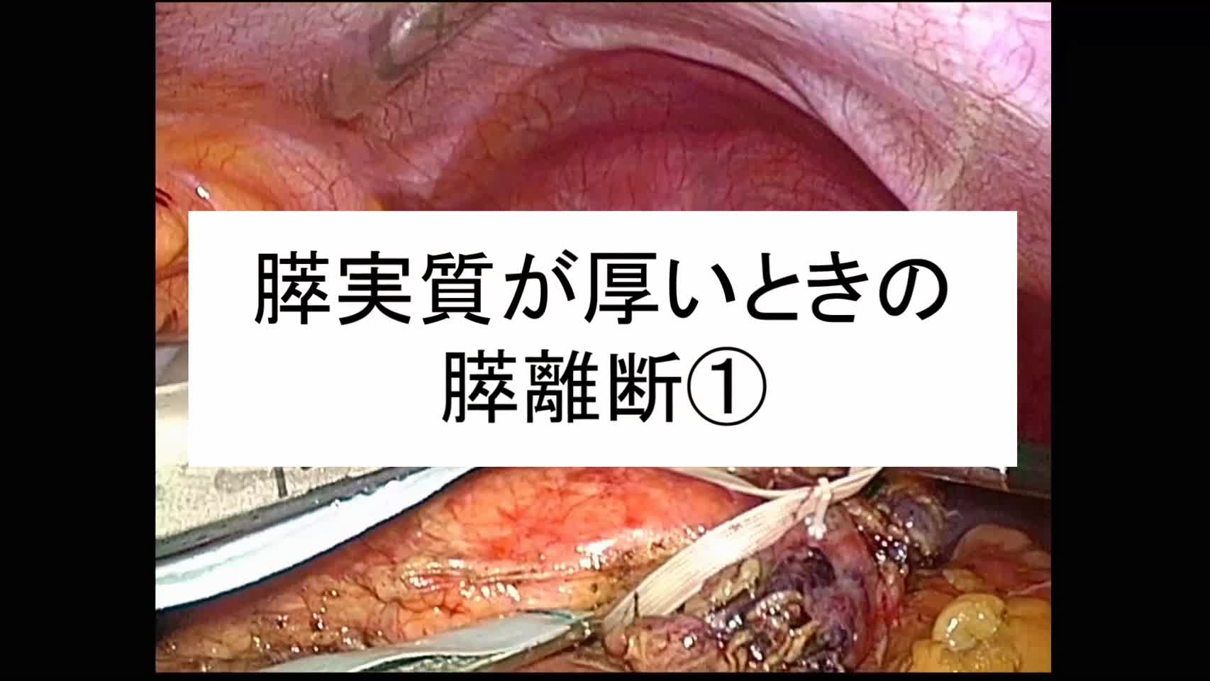 動画8.膵実質が厚いときの膵離断