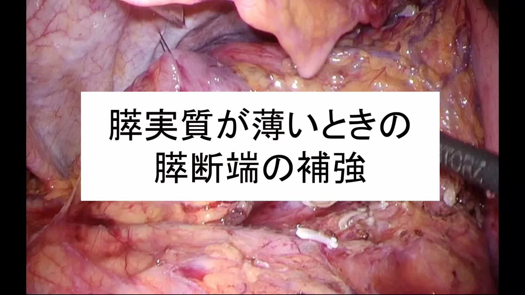 動画9.膵実質が薄いときの膵断端の補強...