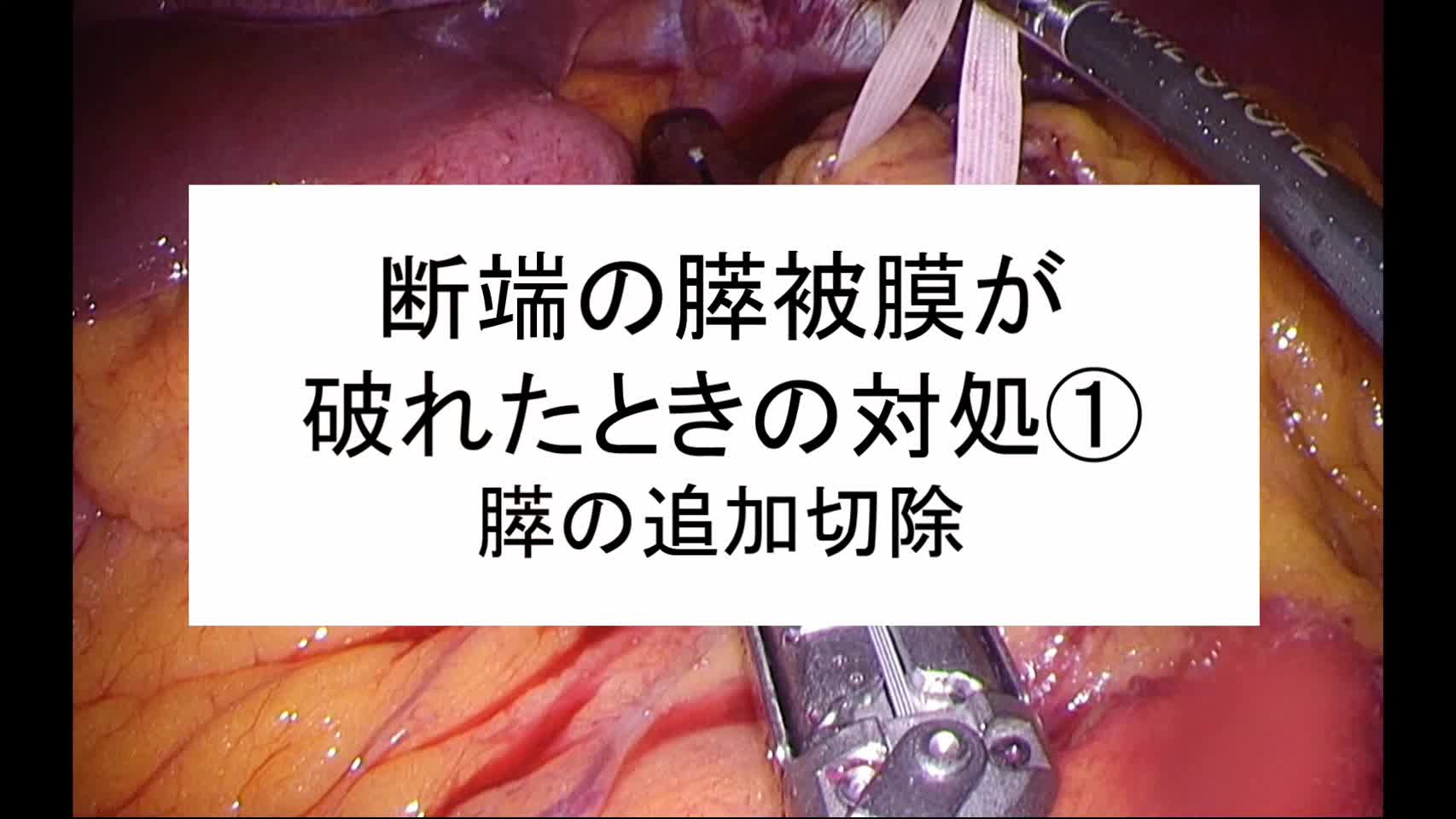 動画10.断端の膵被膜が破れたときの対処...