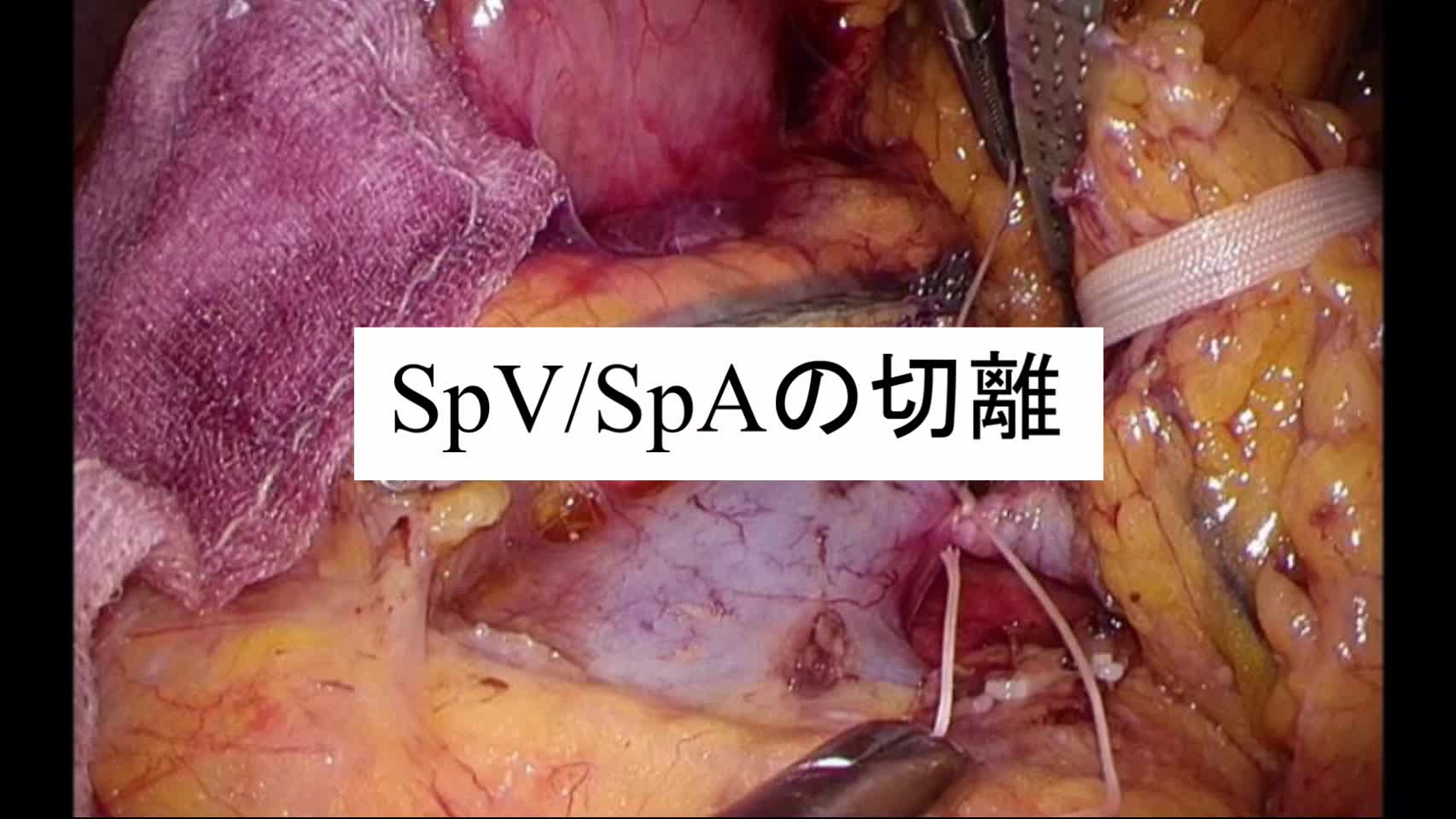 動画11.SpV・SpAの切離、膵体尾部・脾の剥離...