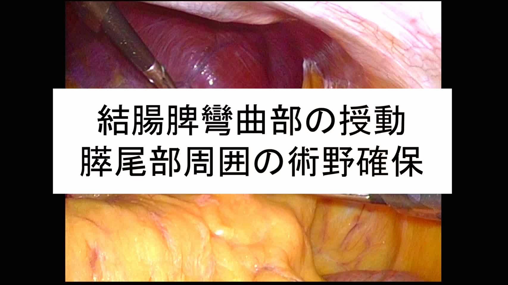 動画1. 結腸脾彎曲部の授動・膵尾部周囲の術野確保...