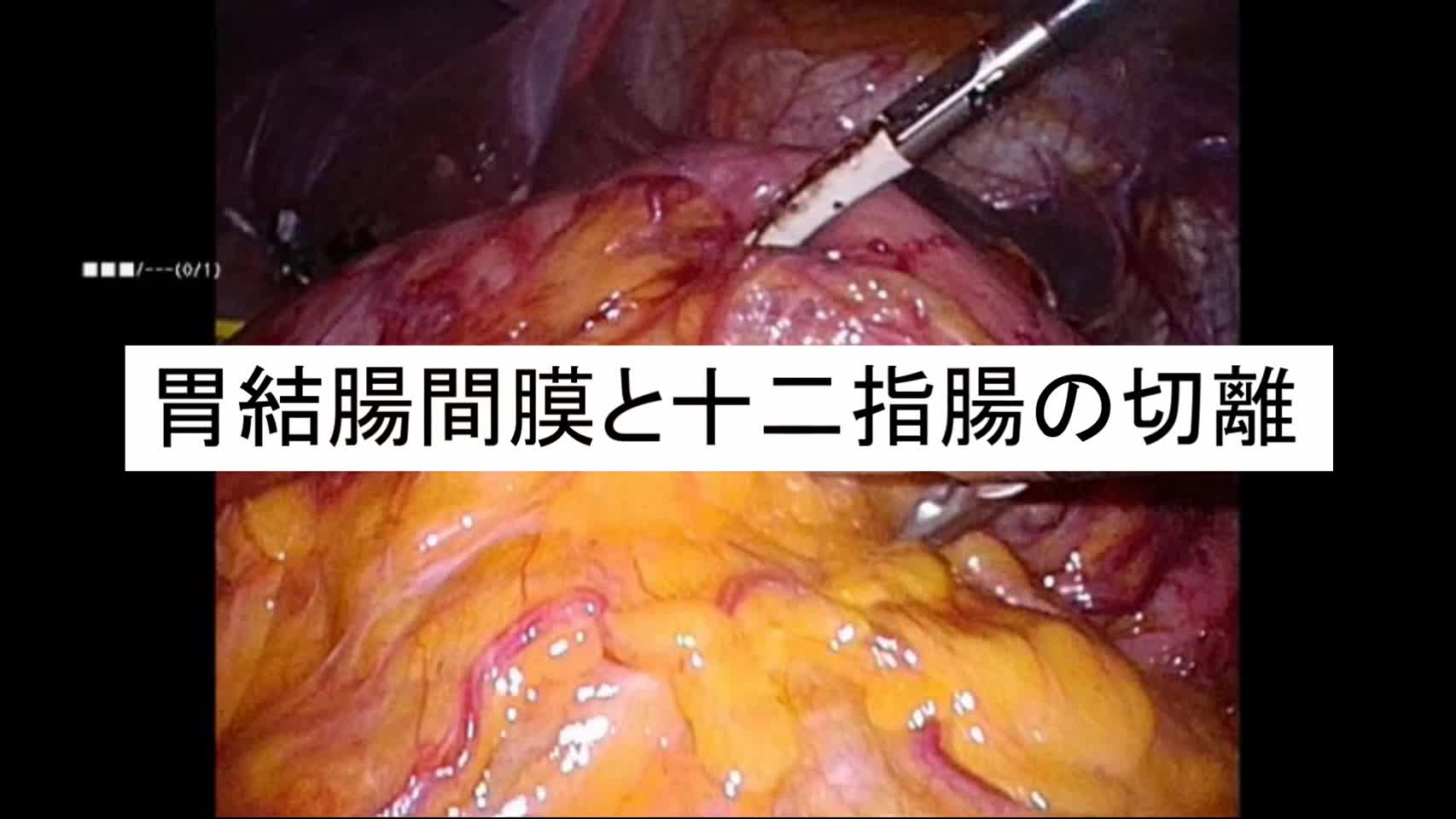 動画3. 胃結腸間膜と十二指腸の切離