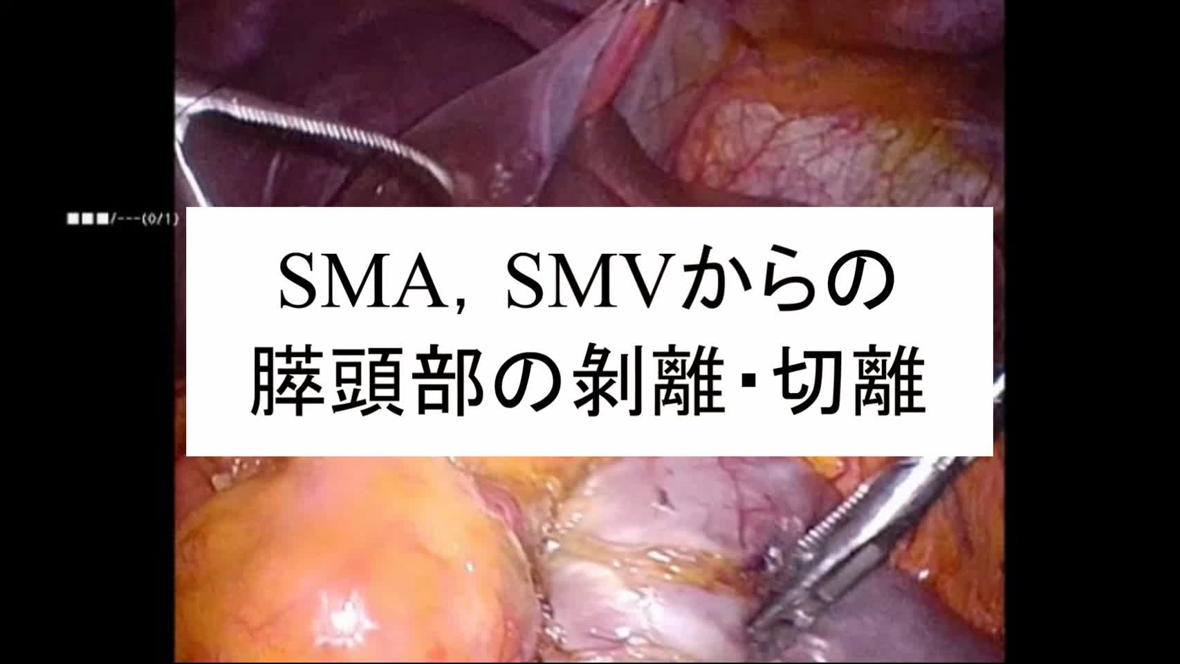 動画6. SMA, SMVからの膵頭部の剥離・切離...