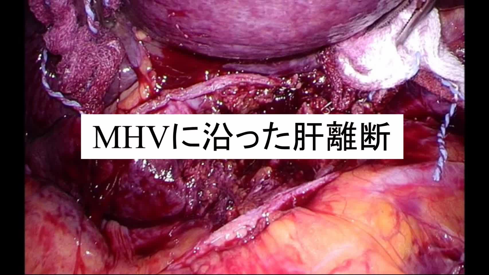 動画3. MHVに沿った肝離断