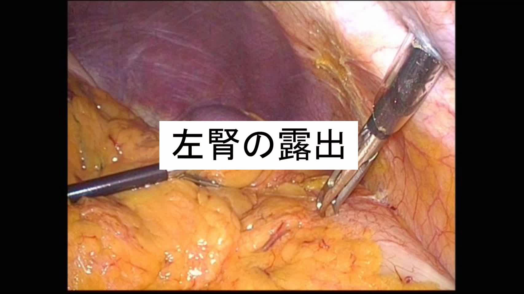 動画2. 左腎の露出