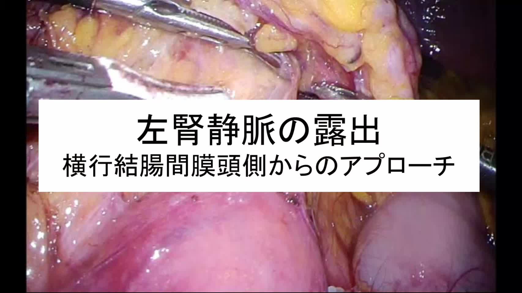 動画3. 左腎静脈の露出(横行結腸間膜頭側からのアプローチ)...