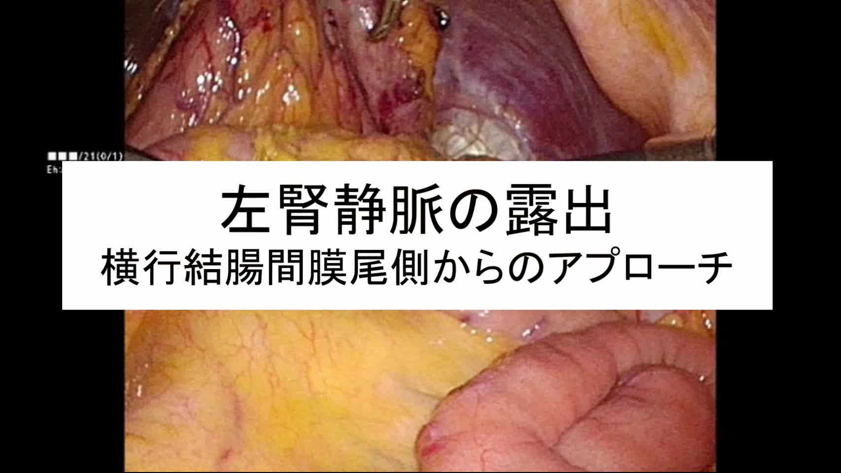 動画4. 左腎静脈の露出(横行結腸間膜尾側からのアプローチ)...