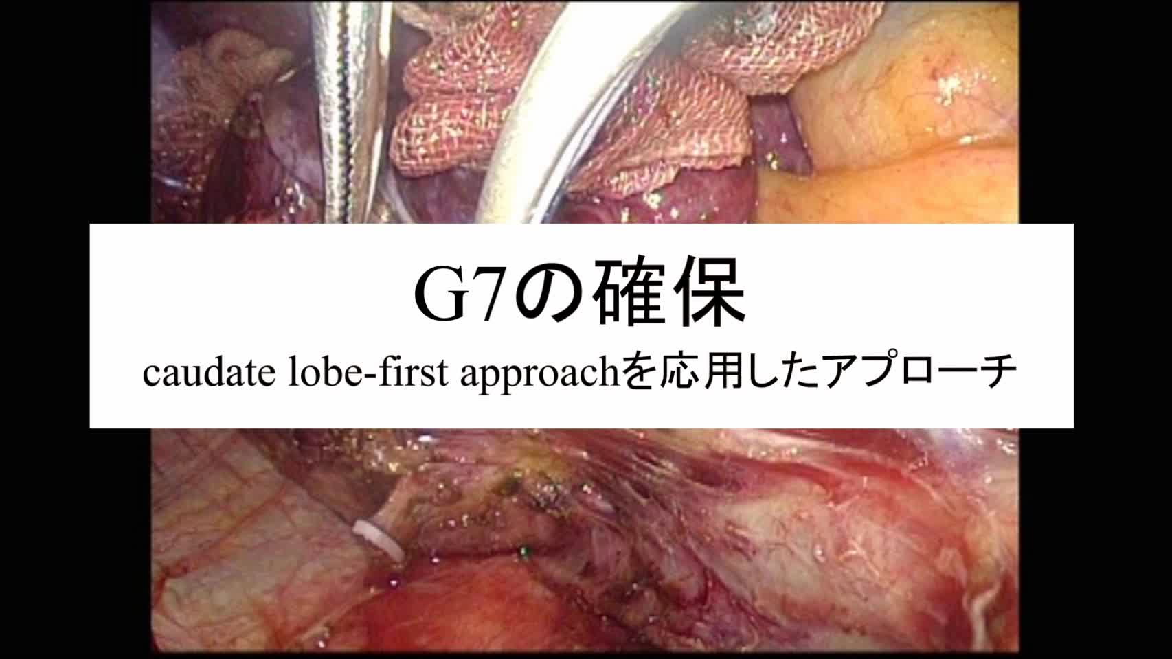 動画2. G7の確保　caudate lobe-first approachを応用したアプローチ...