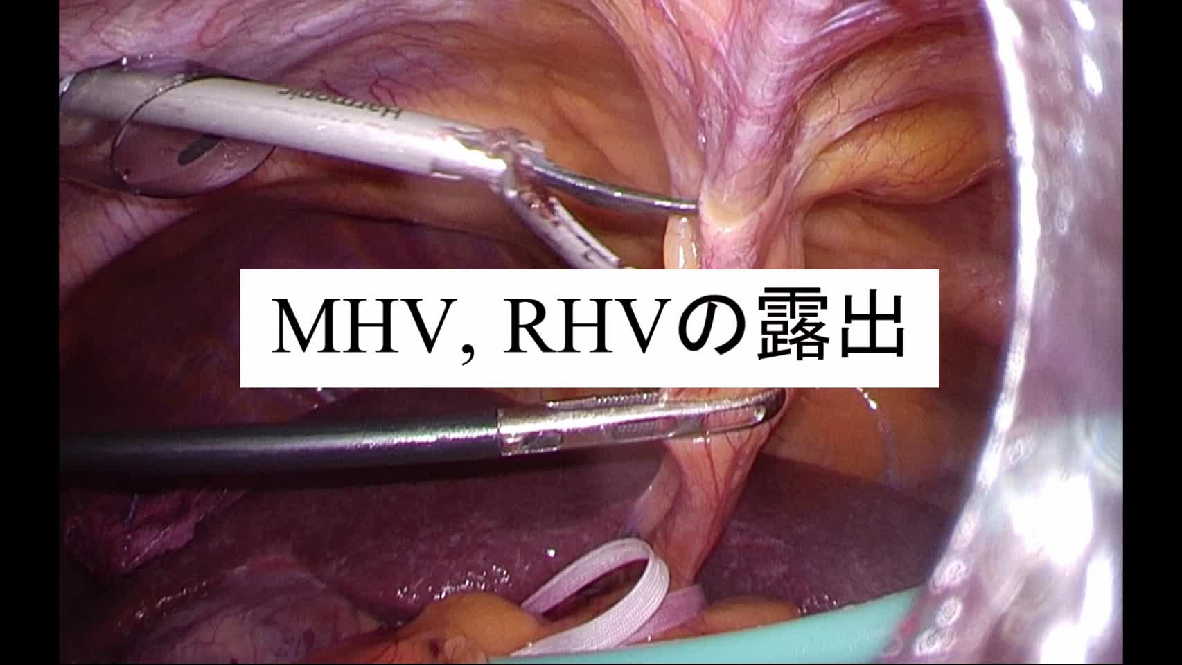 動画2. MHV, RHVの露出