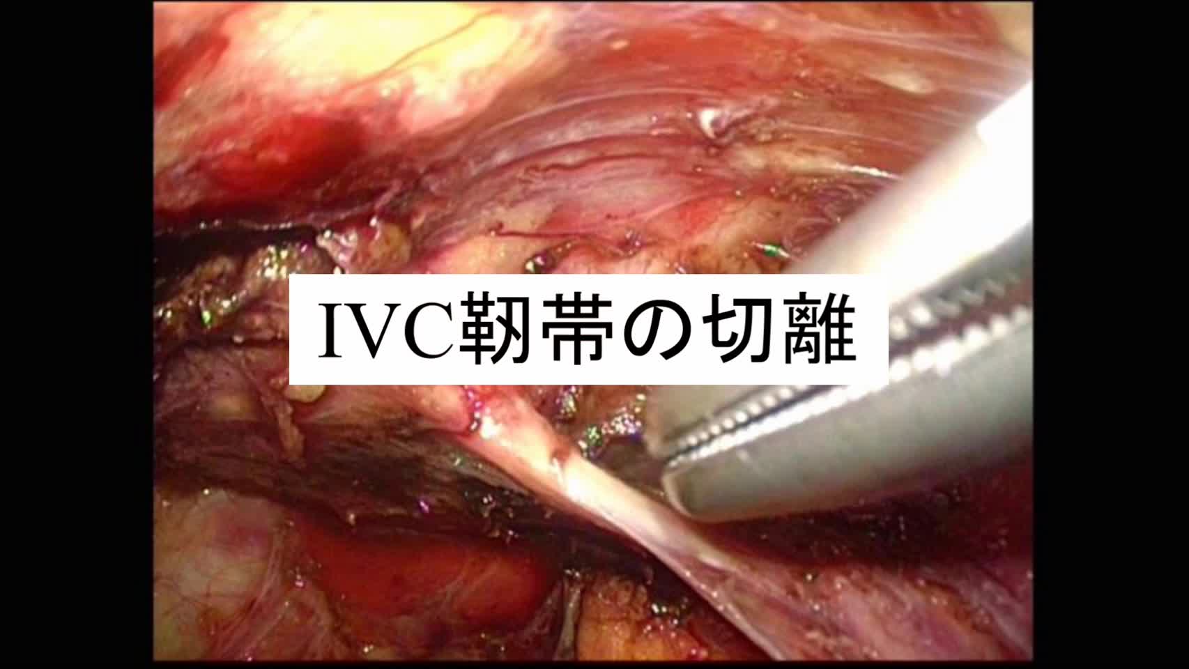 動画2. IVC靭帯の切離