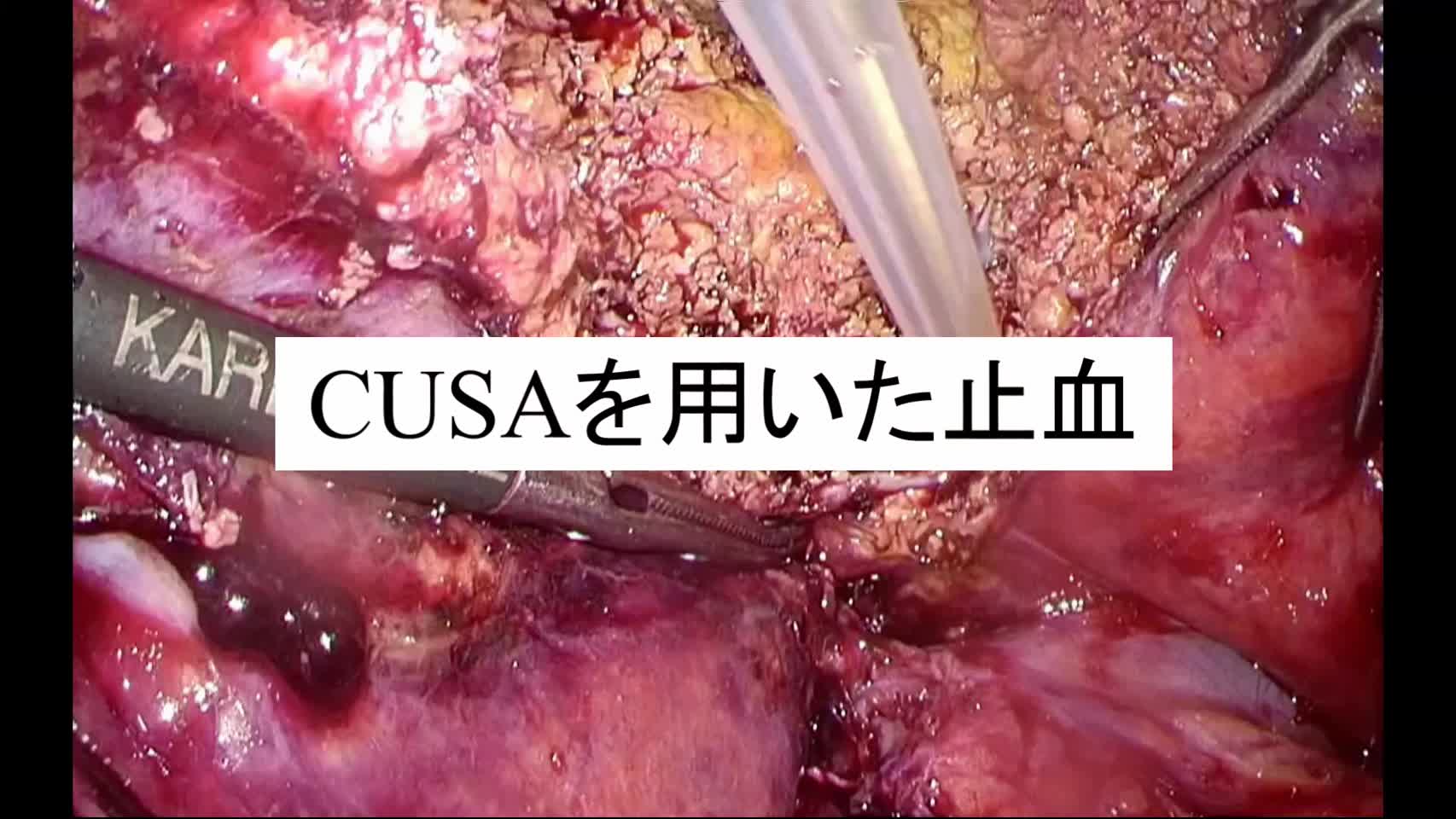 動画4. CUSAを用いた止血