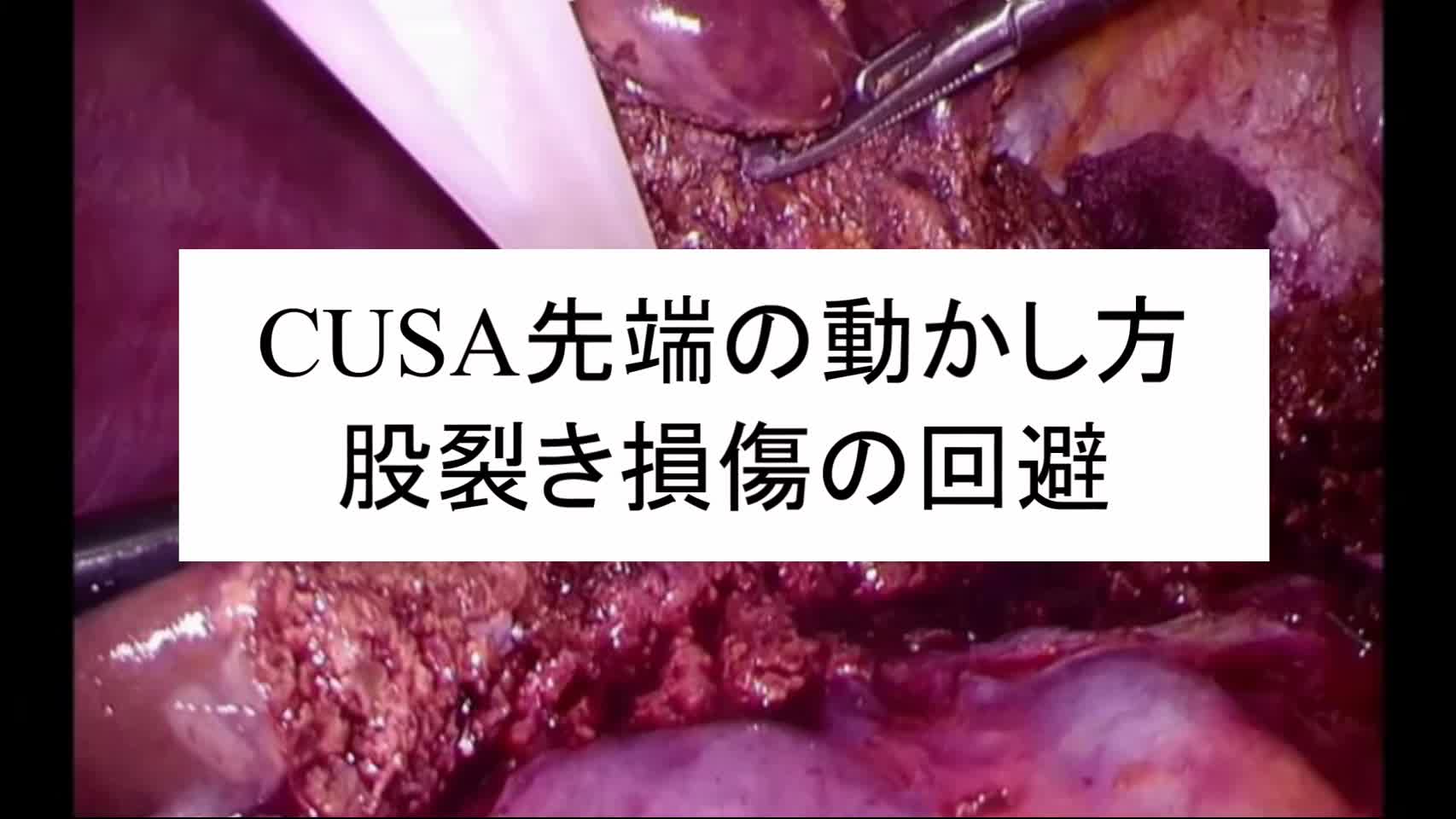 動画5. CUSA先端の動かし方