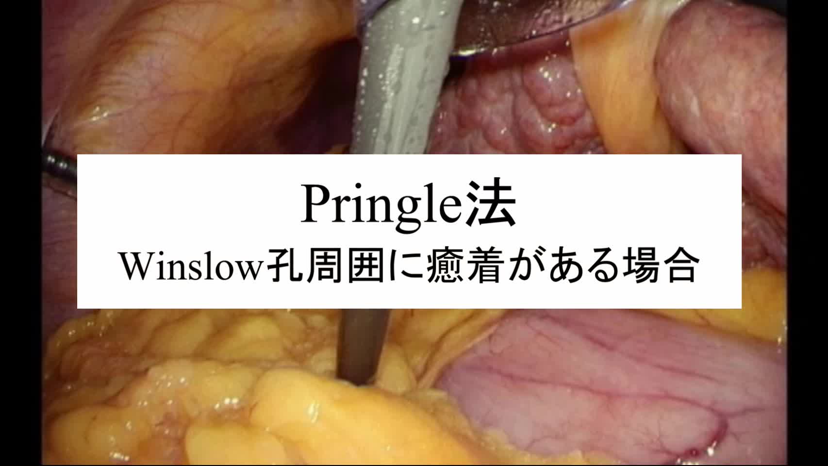 動画7. Pringle法(Winslow孔周囲に癒着がある場合)...