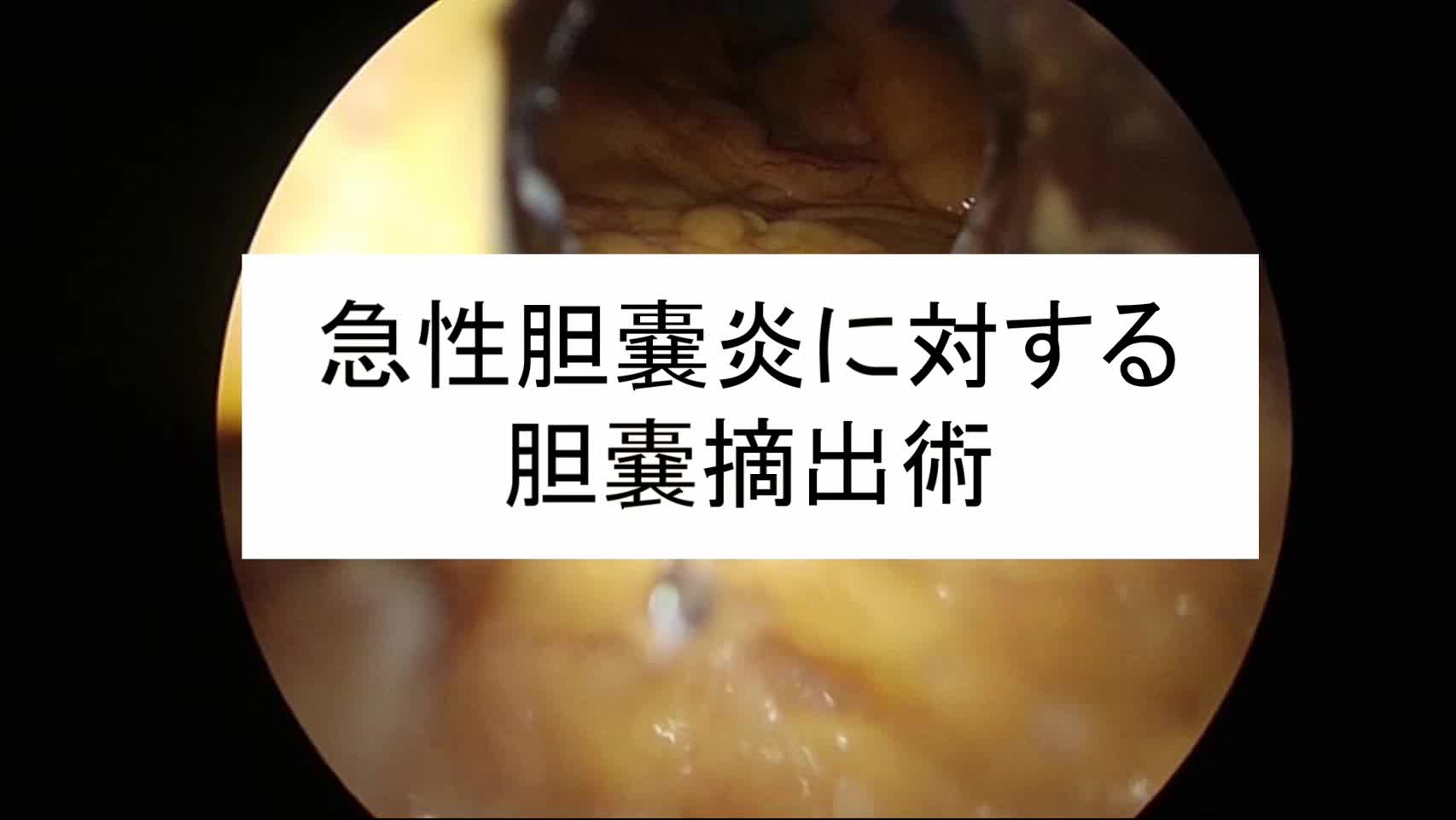 動画1. 胆嚢炎に対する胆嚢摘出術