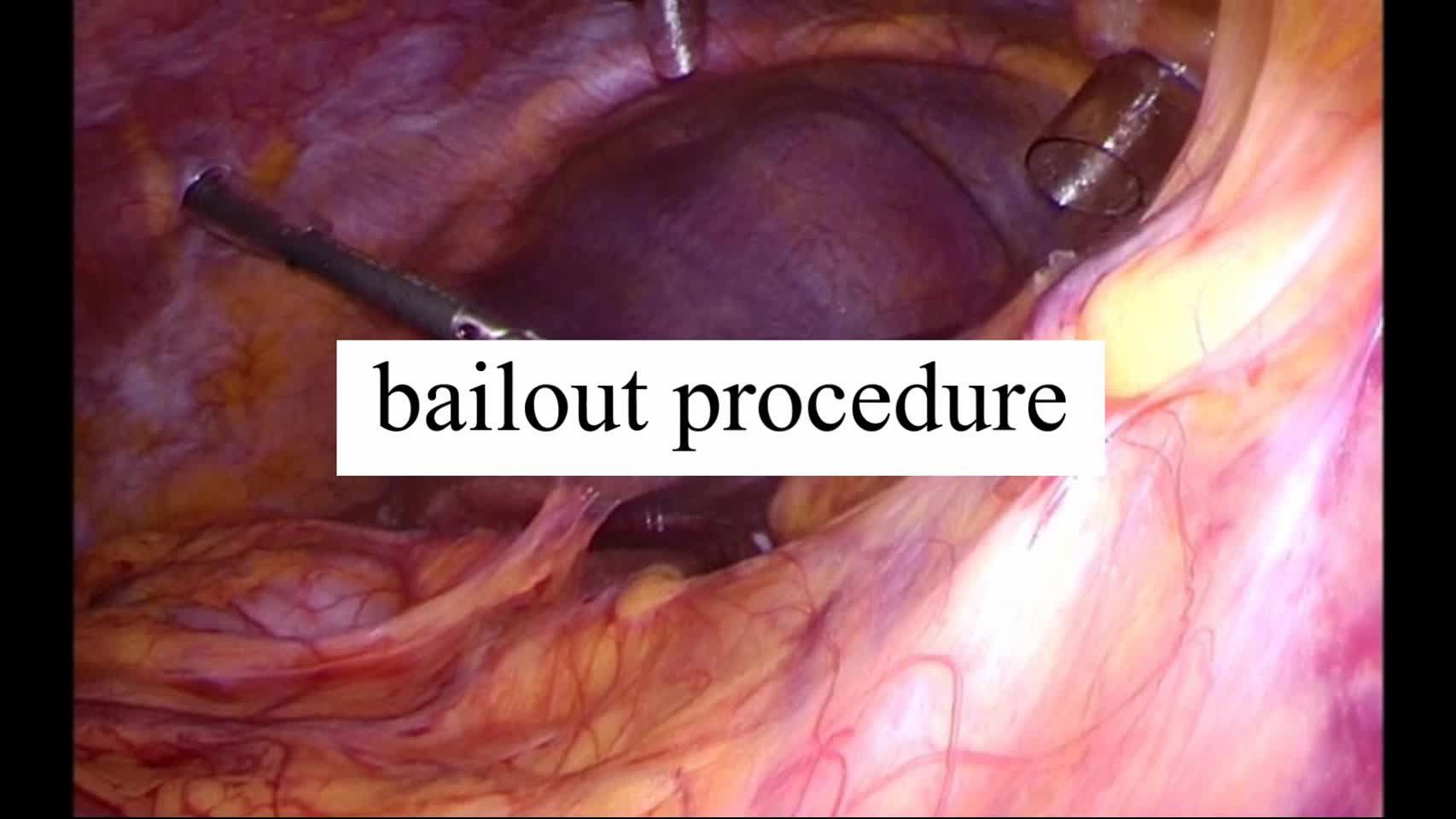 動画2. bailout procedure