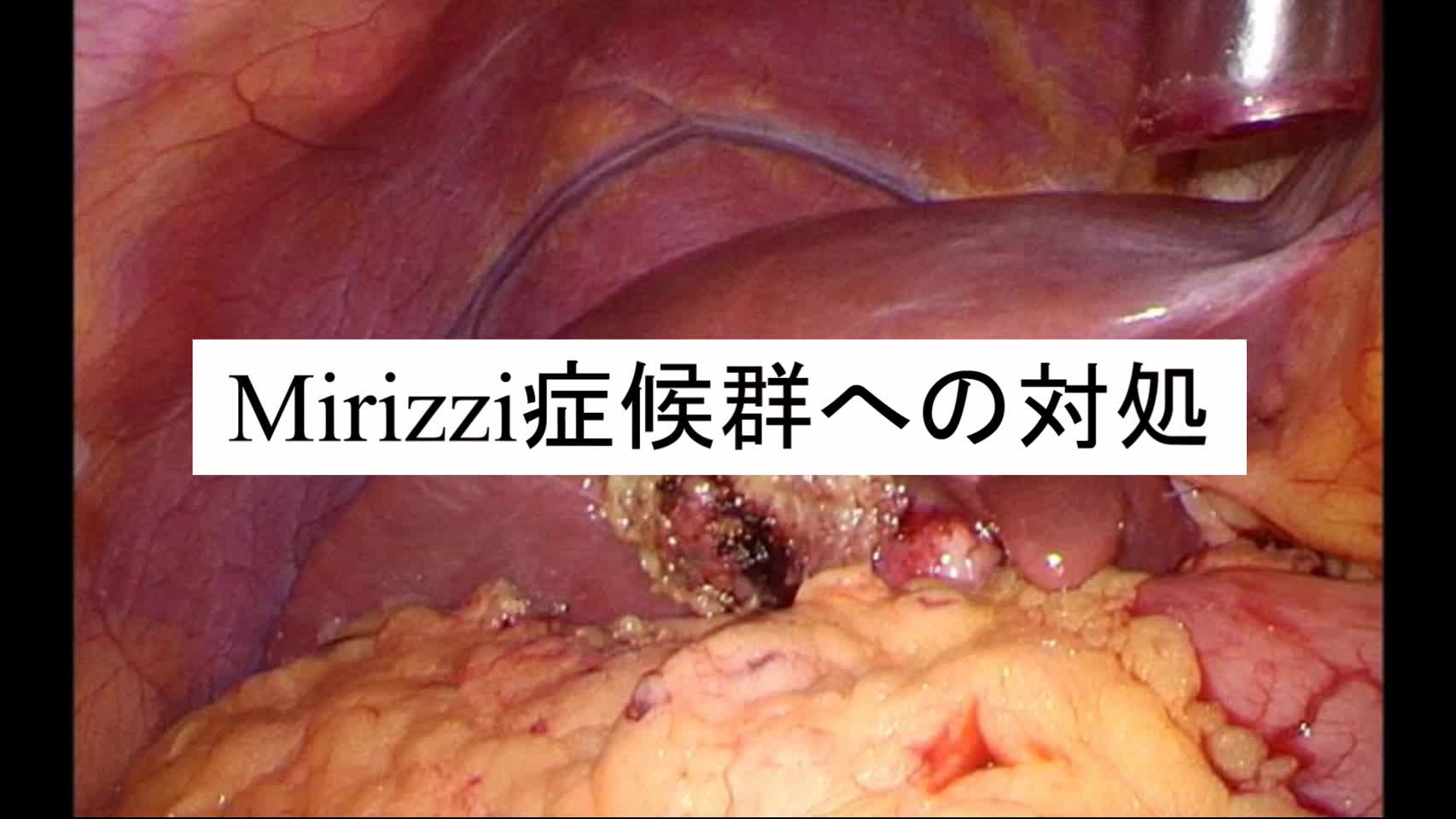 動画3. Mirizzi 症候群への対処